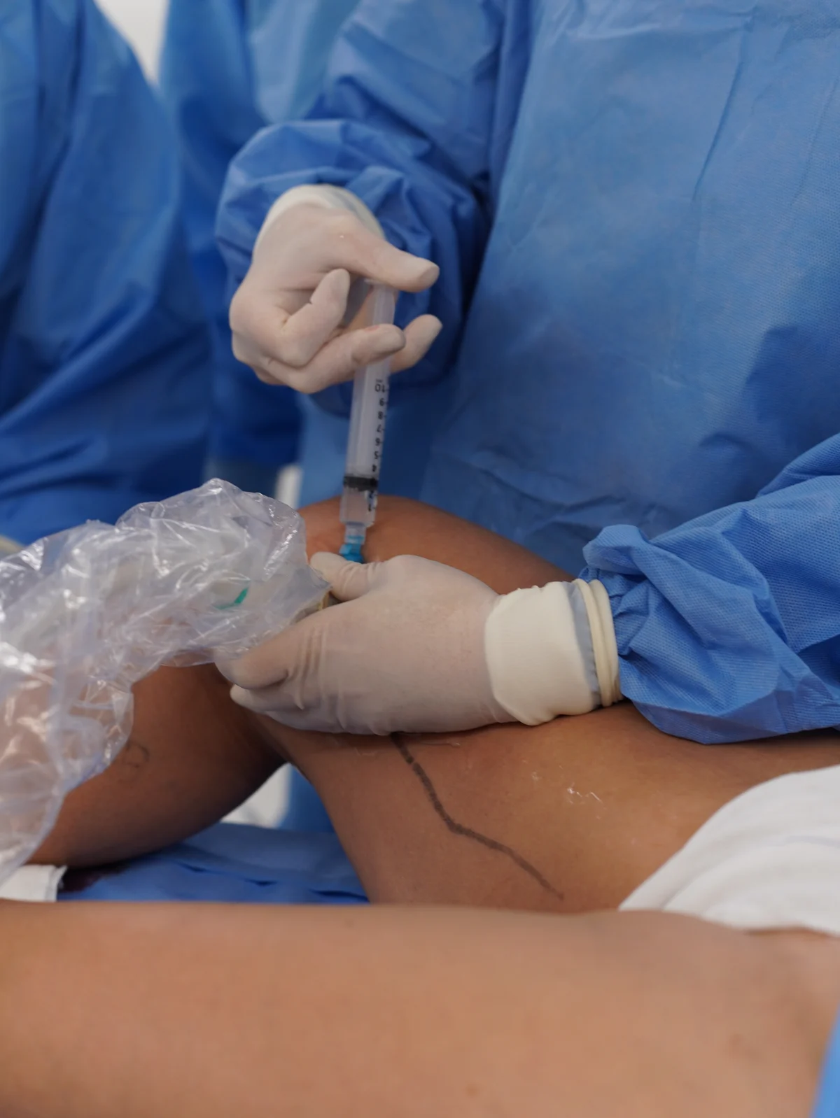 Procedimento vascular realizado com orientação por ultrassom